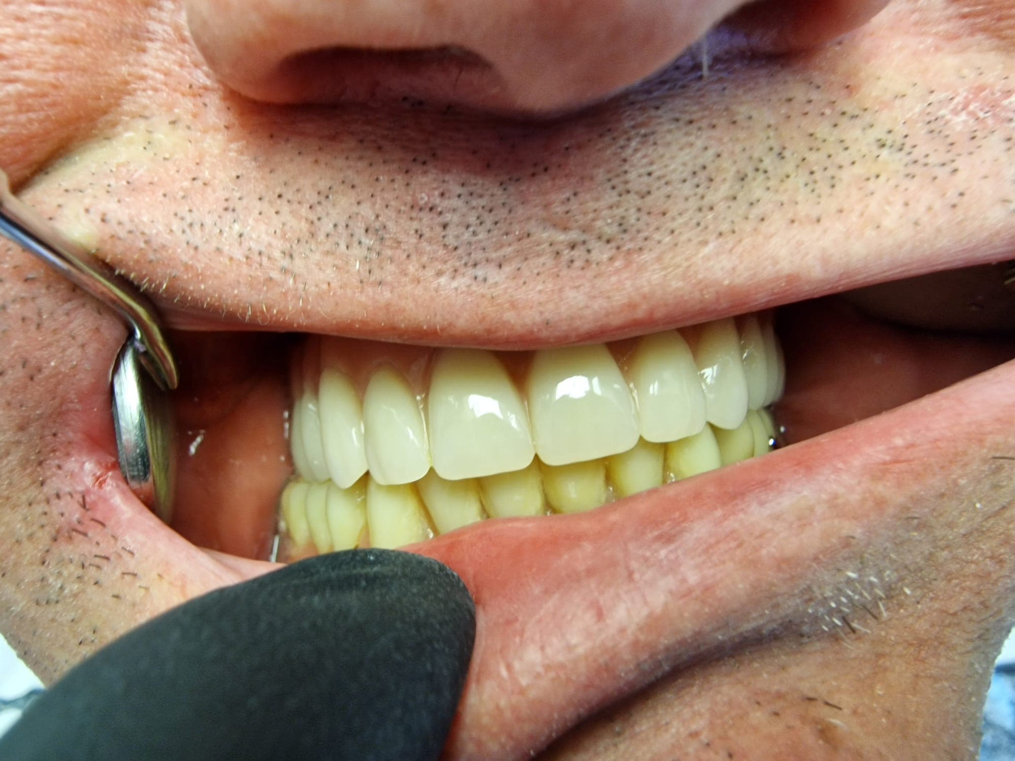 Teleskopierende Prothese - Bild 10