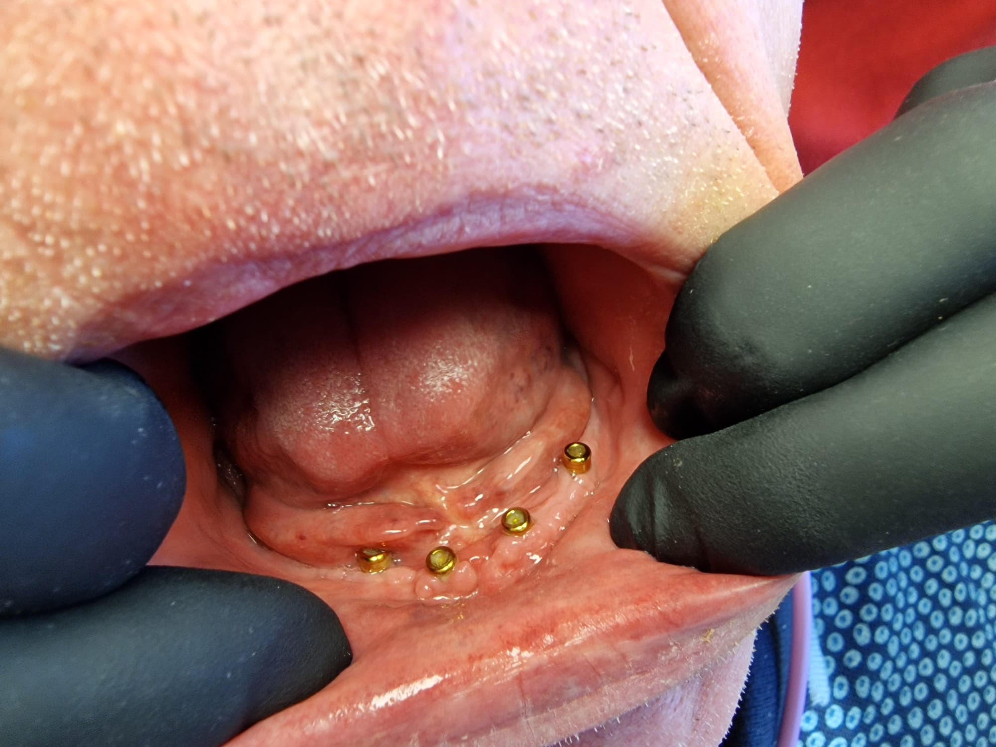 Zahnersatz auf Implantate - Bild 11