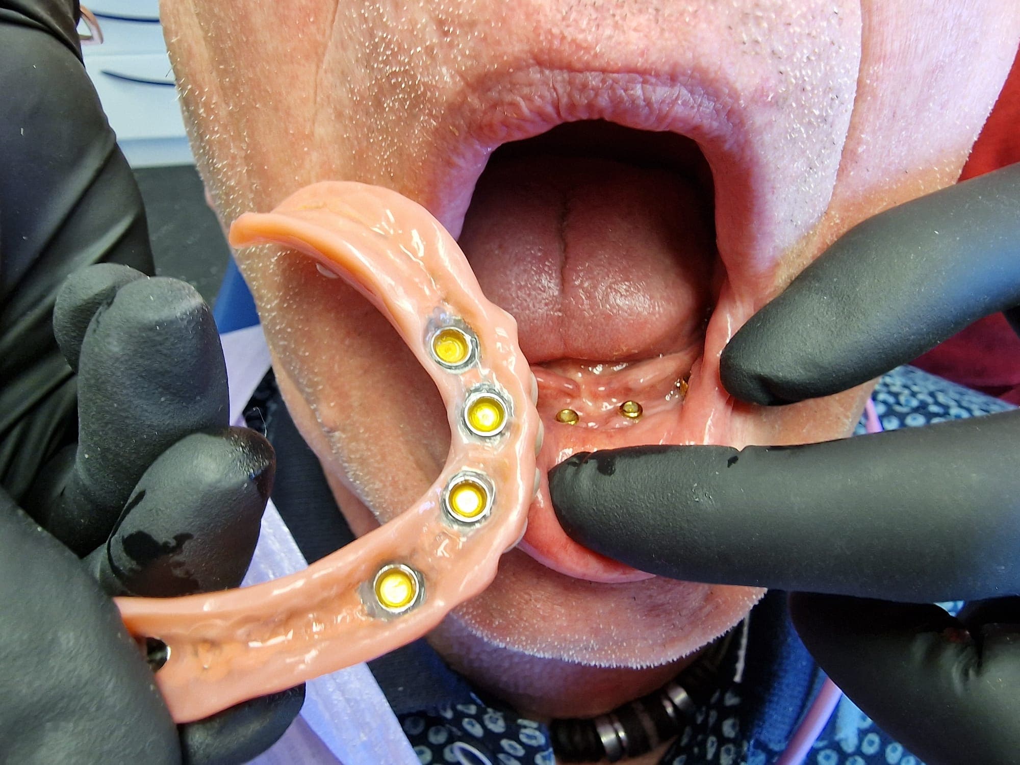 Zahnersatz auf Implantate - Bild 12