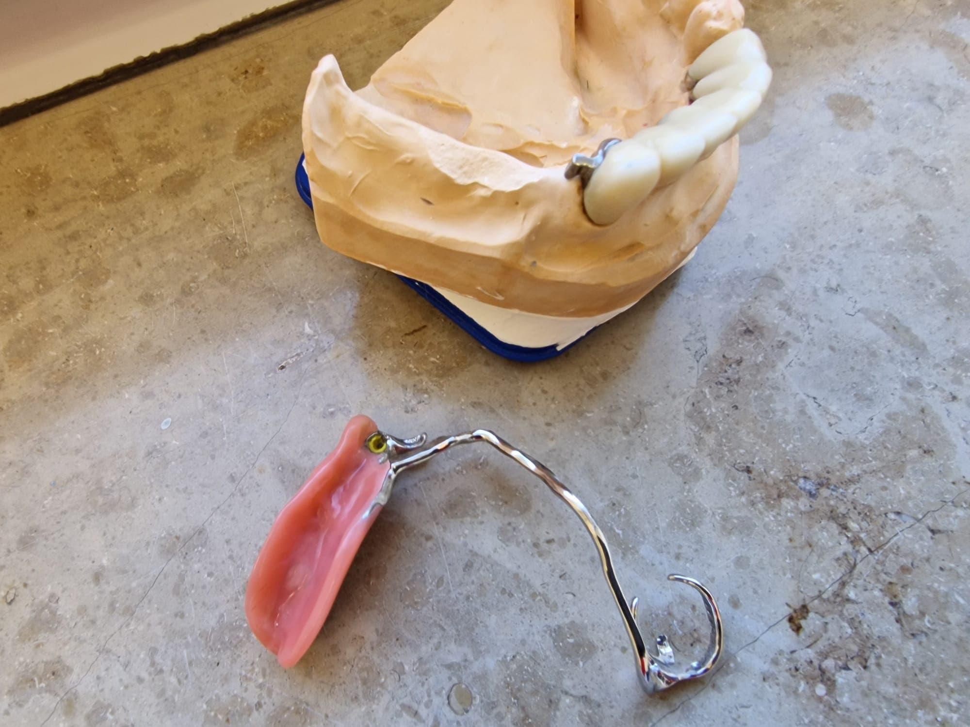 Teleskopierende Prothese - Bild 16