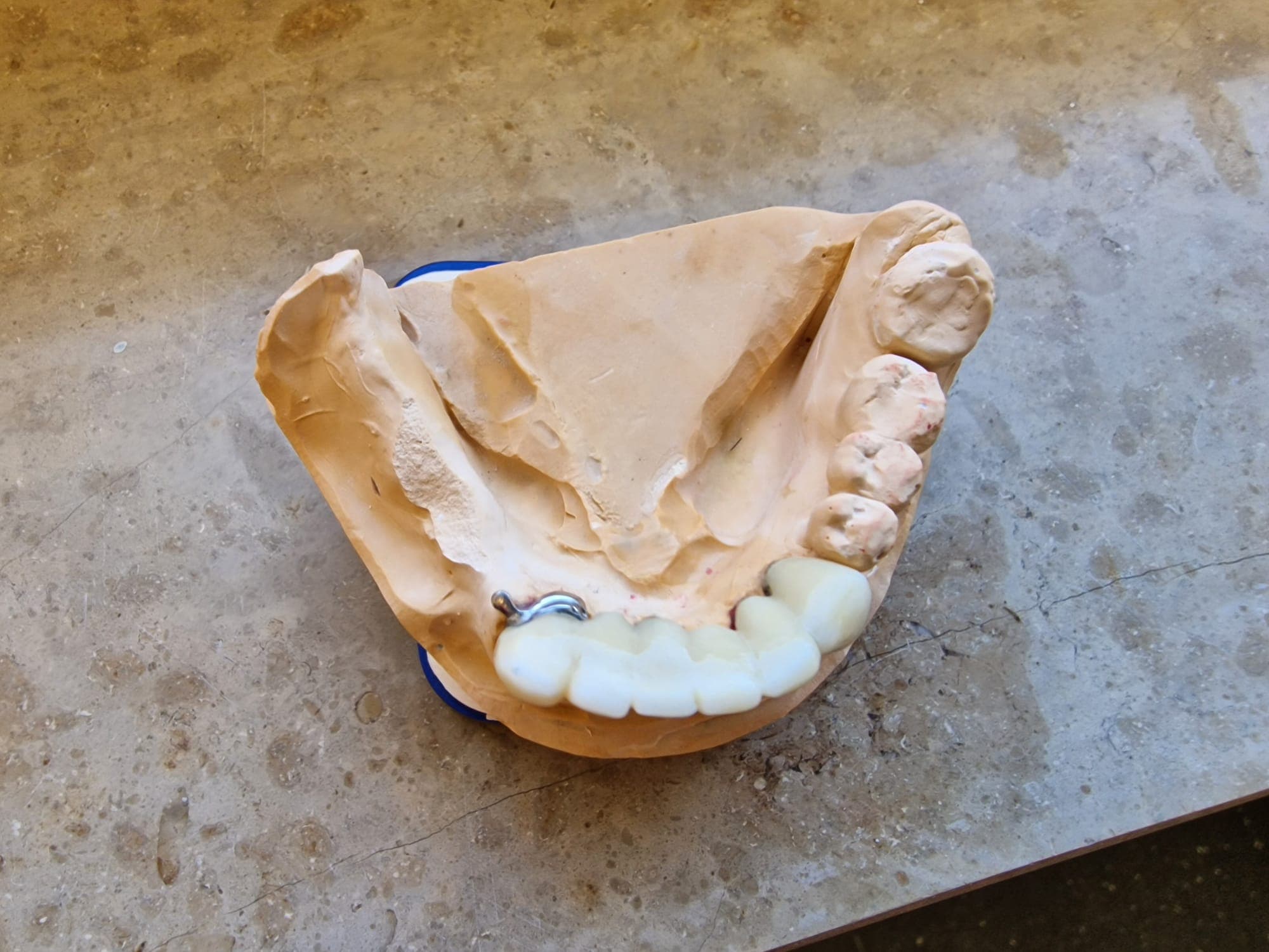 Teleskopierende Prothese - Bild 18