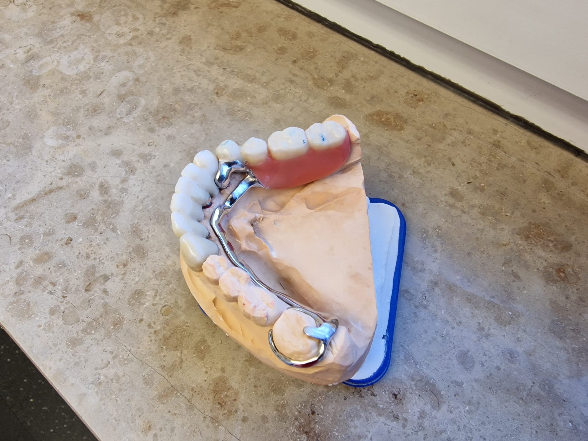 Teleskopierende Prothese - Bild 19