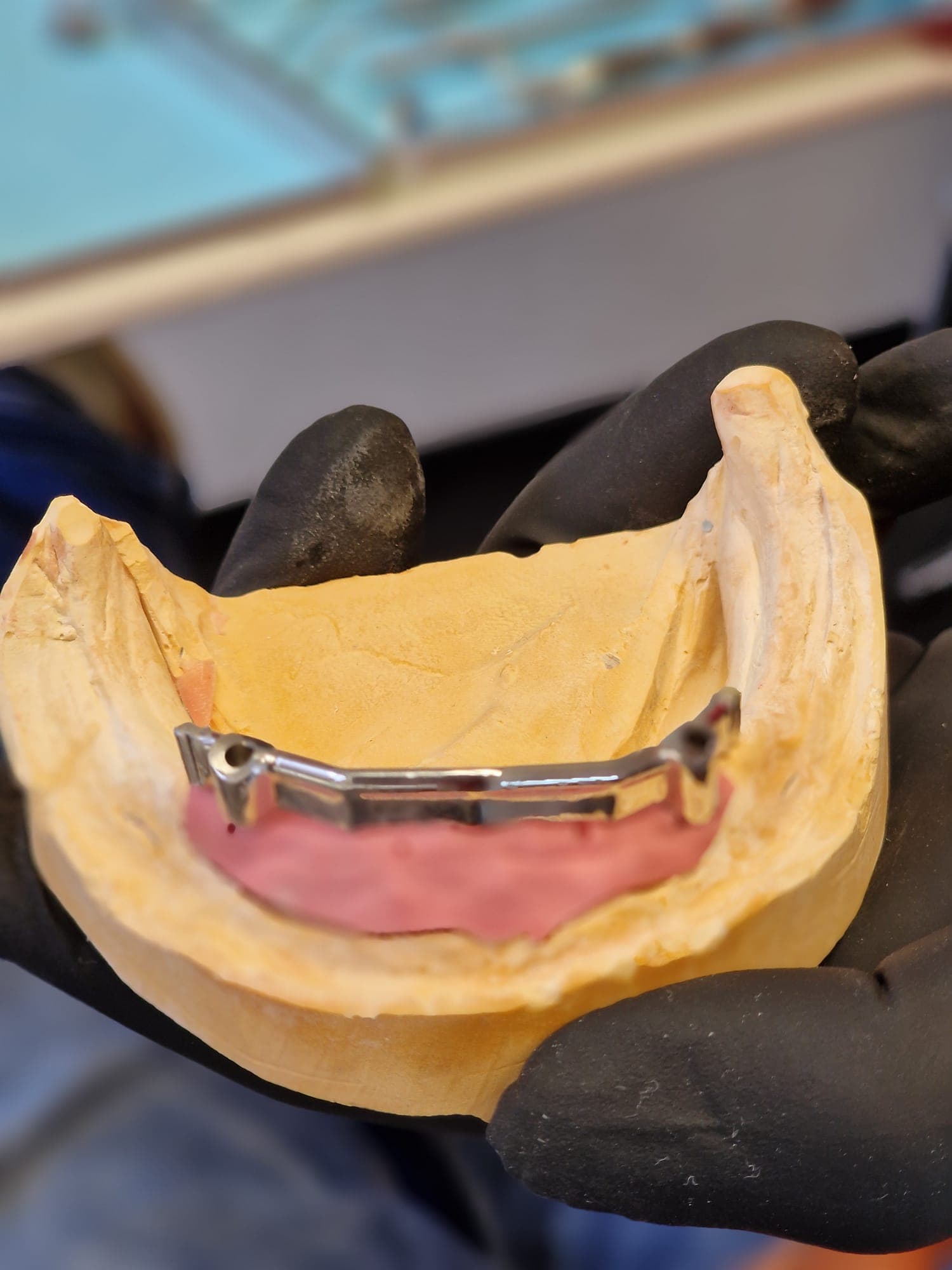 Zahnersatz auf Implantate - Bild 2