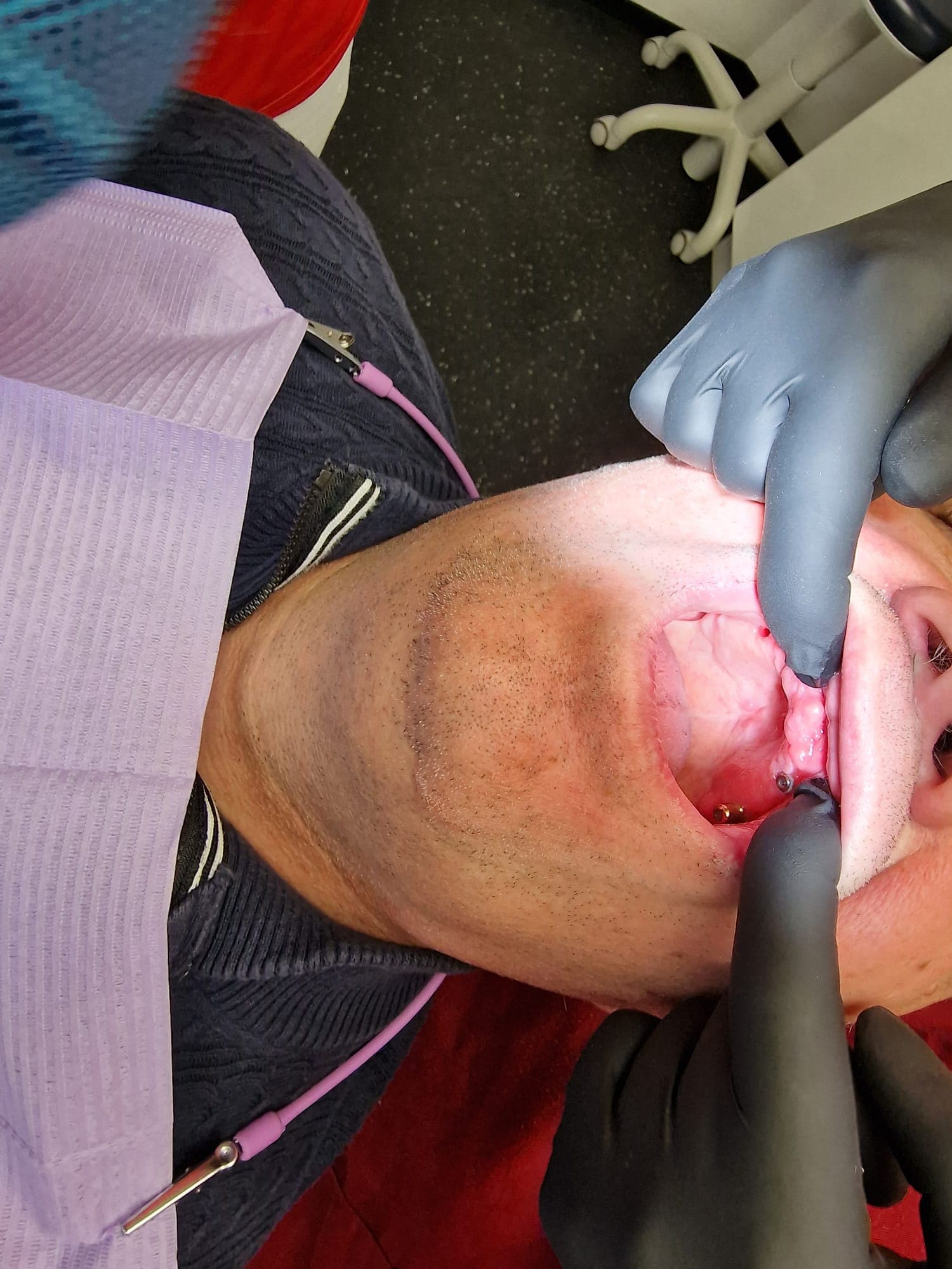 Teleskopierende Prothese - Bild 2