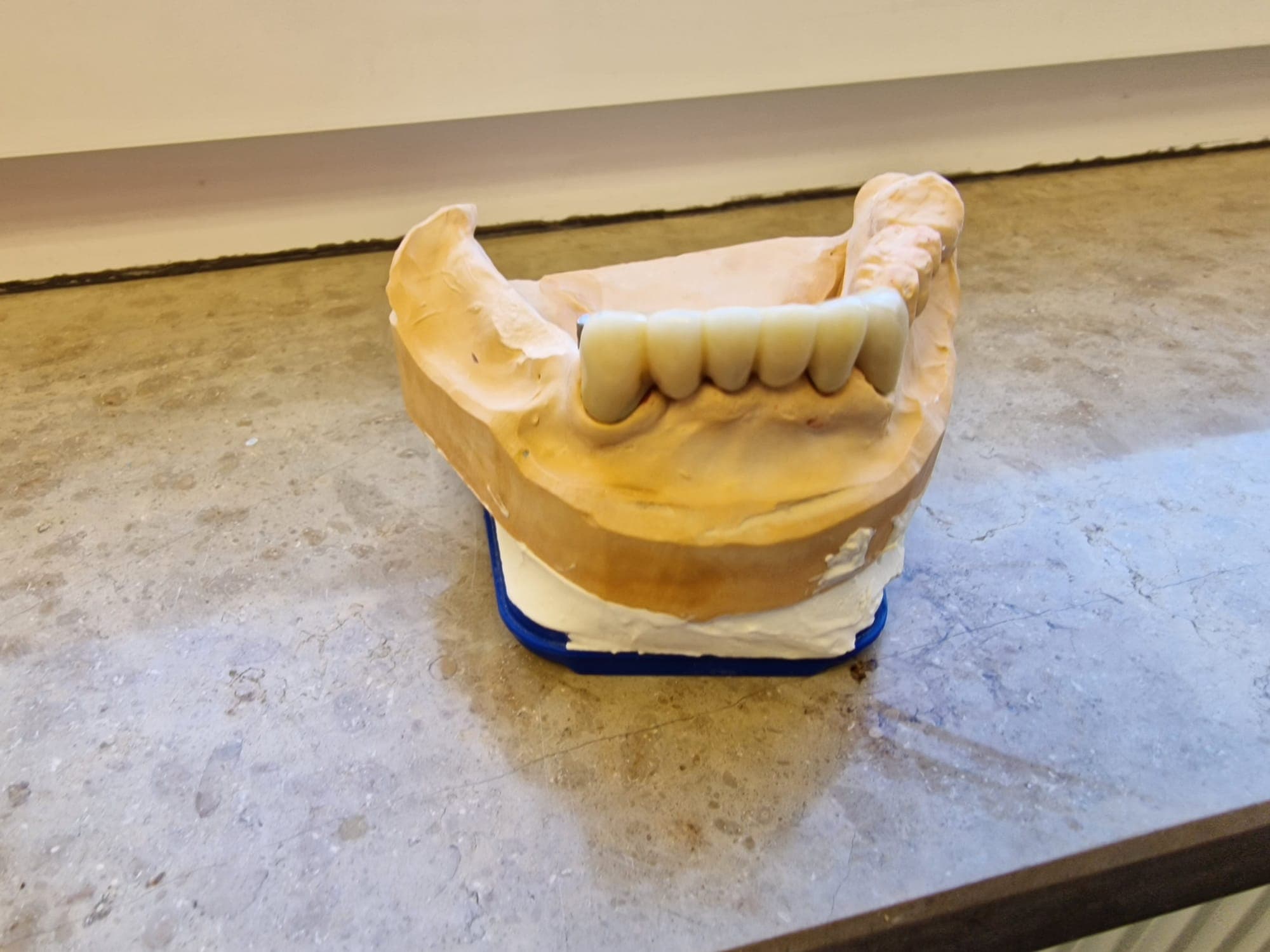 Teleskopierende Prothese - Bild 20