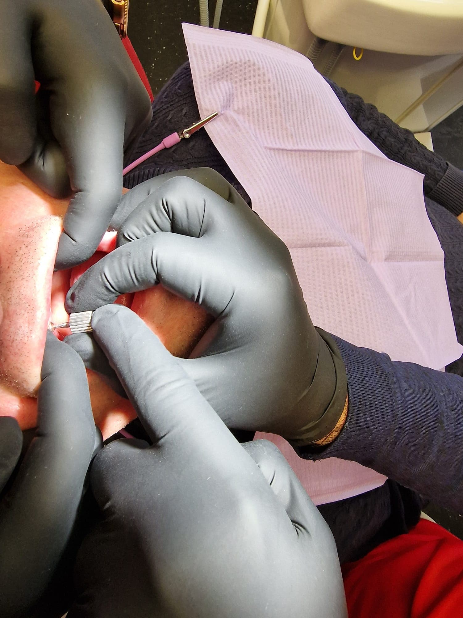 Teleskopierende Prothese - Bild 3