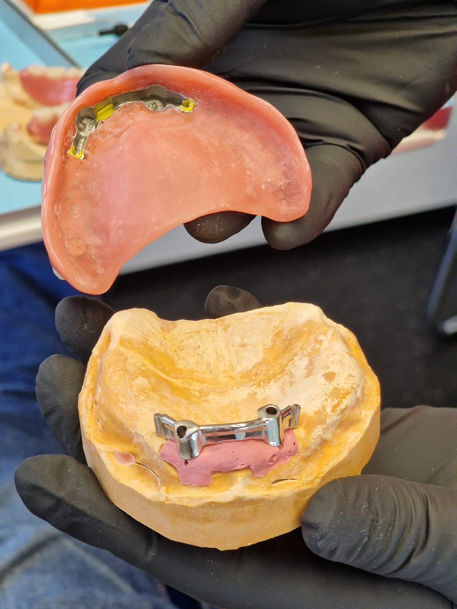 Zahnersatz auf Implantate - Bild 3