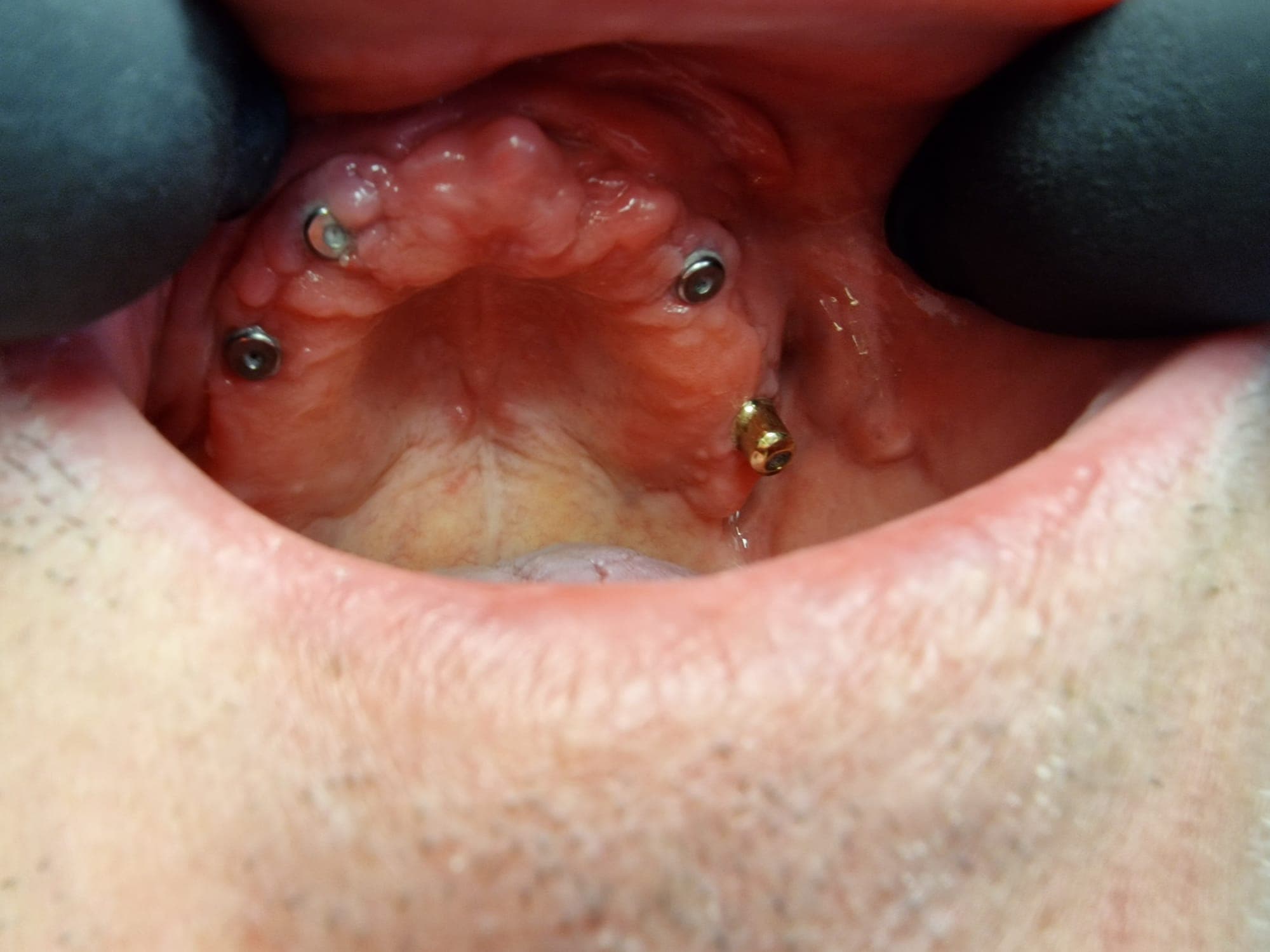 Teleskopierende Prothese - Bild 4