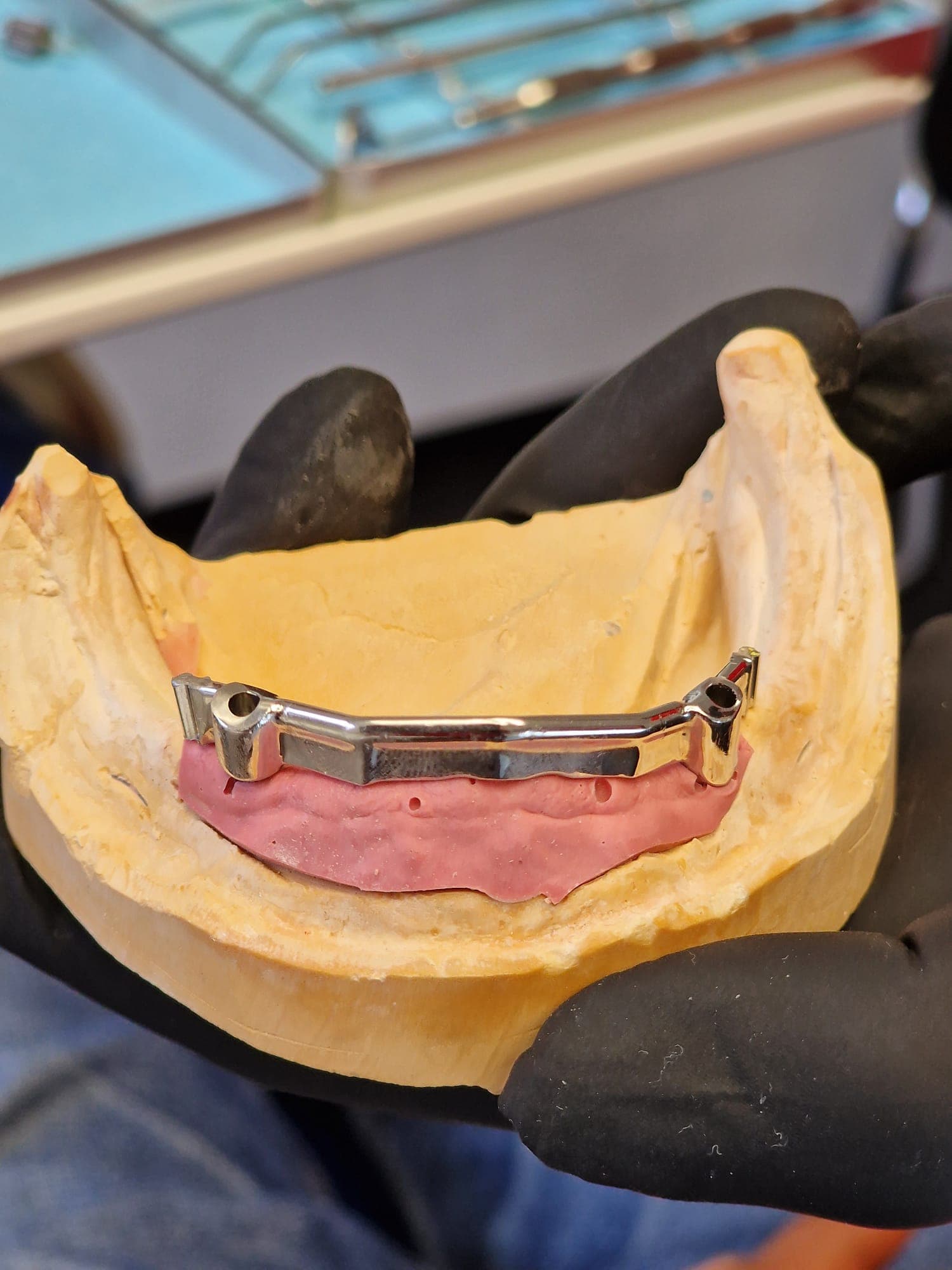 Zahnersatz auf Implantate - Bild 5