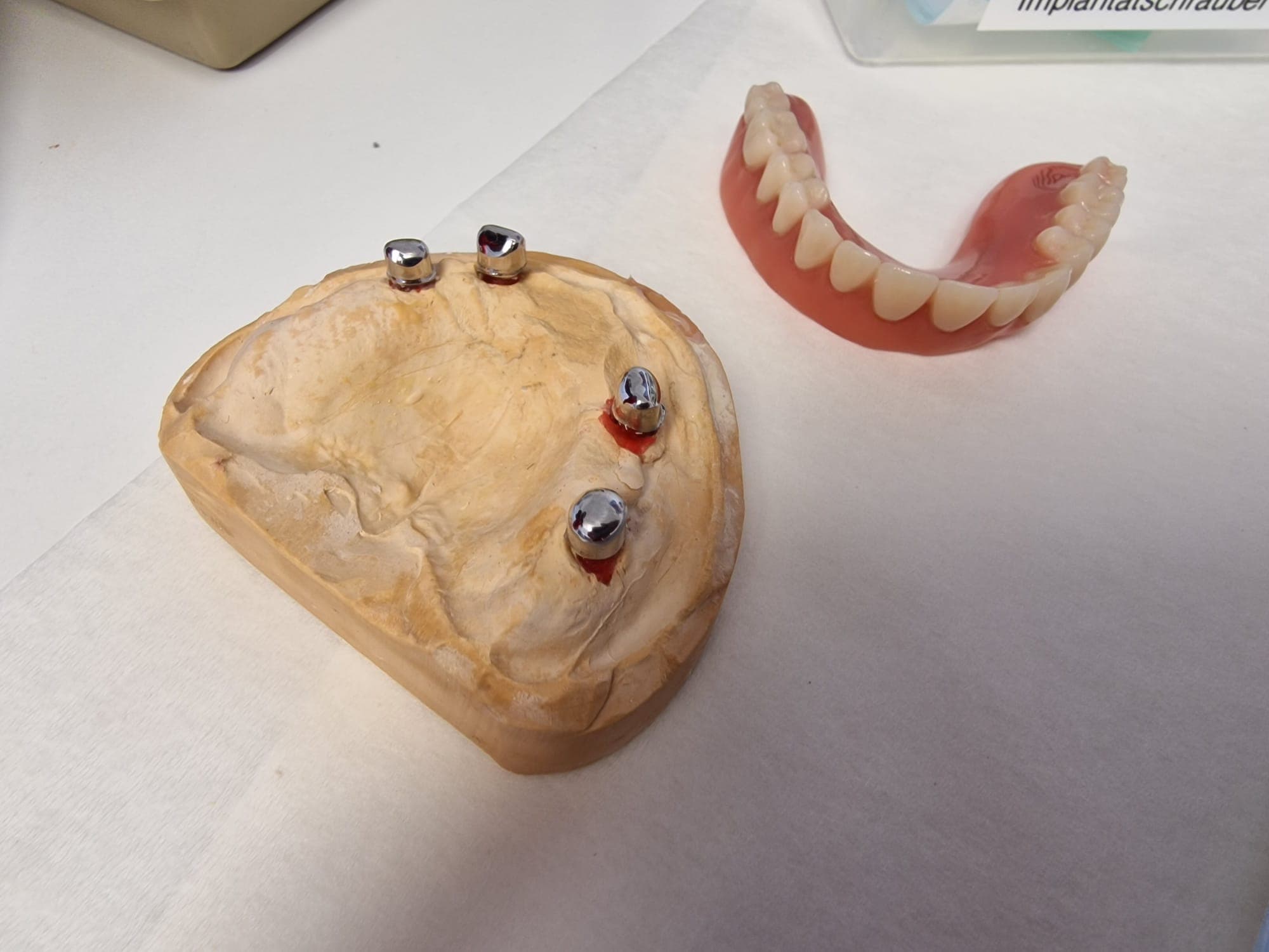 Teleskopierende Prothese - Bild 6