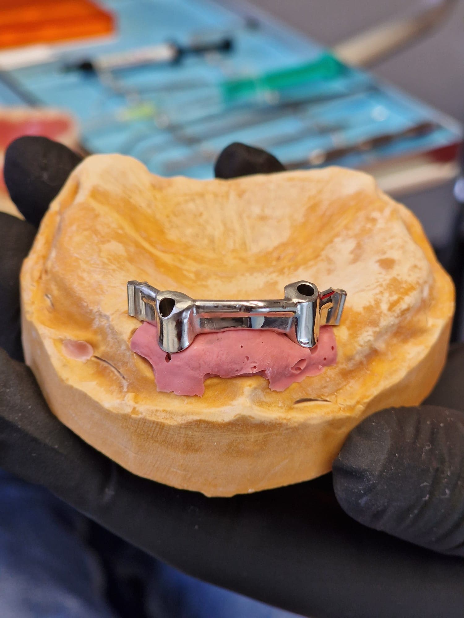 Zahnersatz auf Implantate - Bild 6