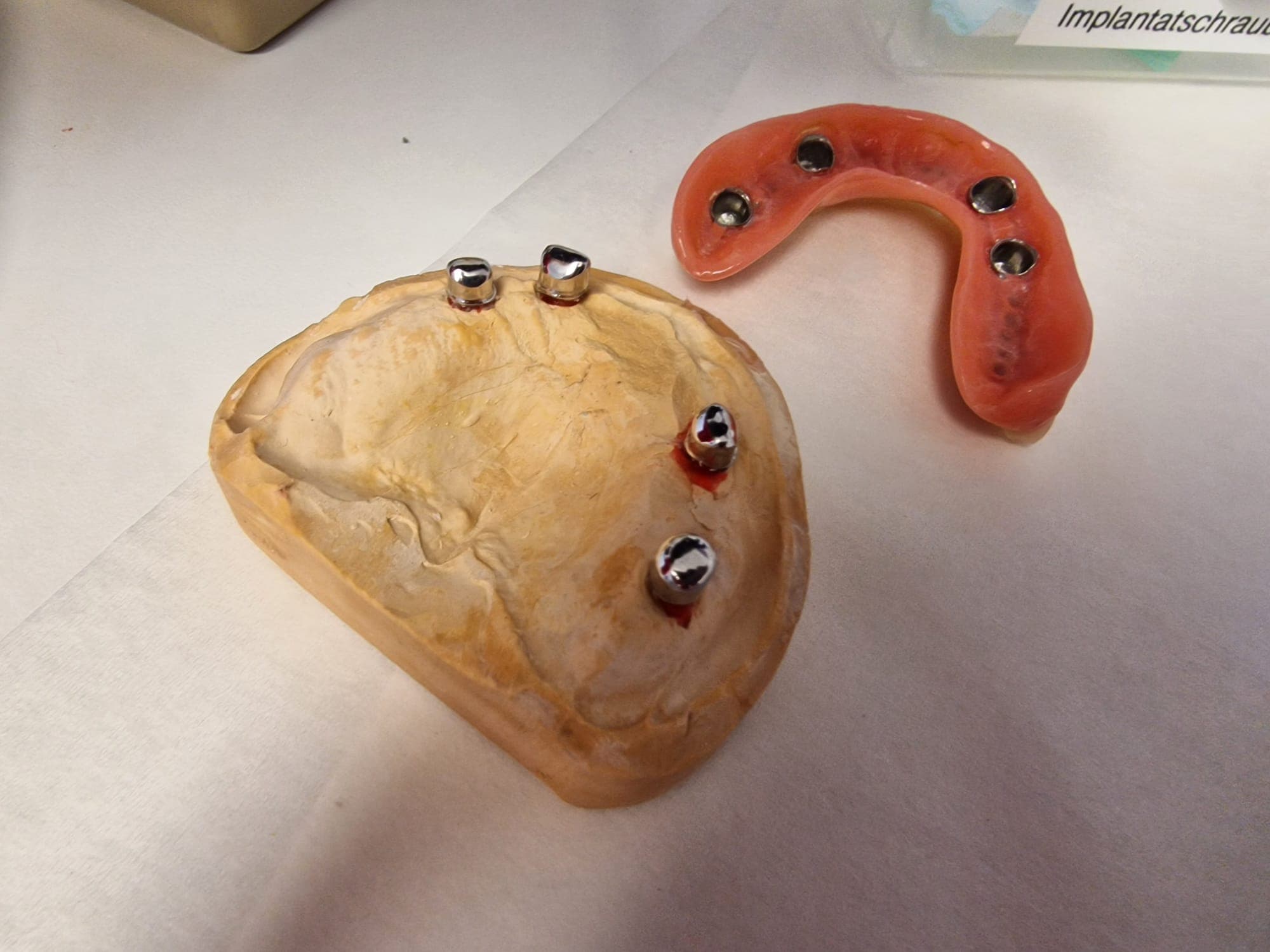 Teleskopierende Prothese - Bild 7