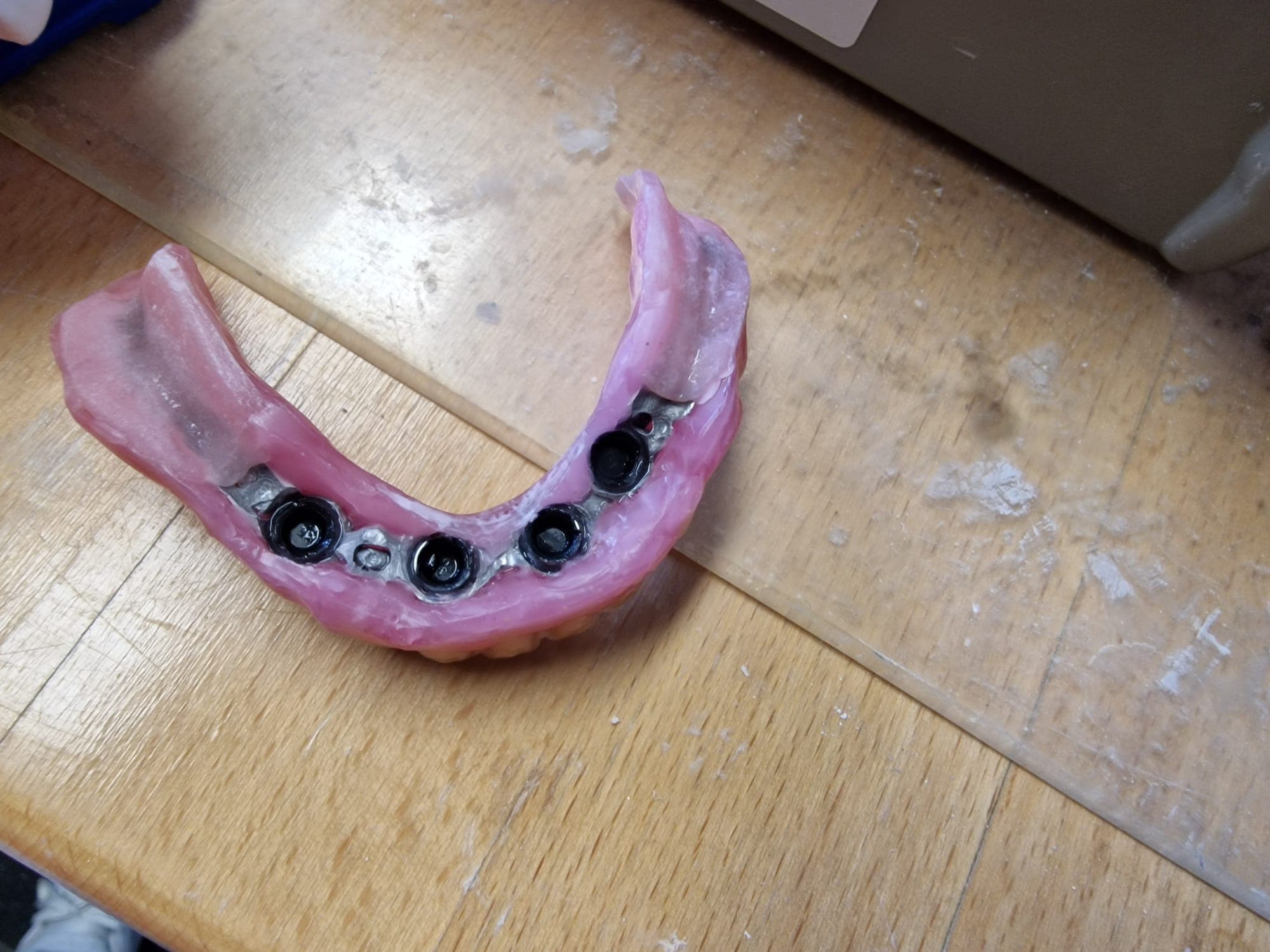 Zahnersatz auf Implantate - Bild 7