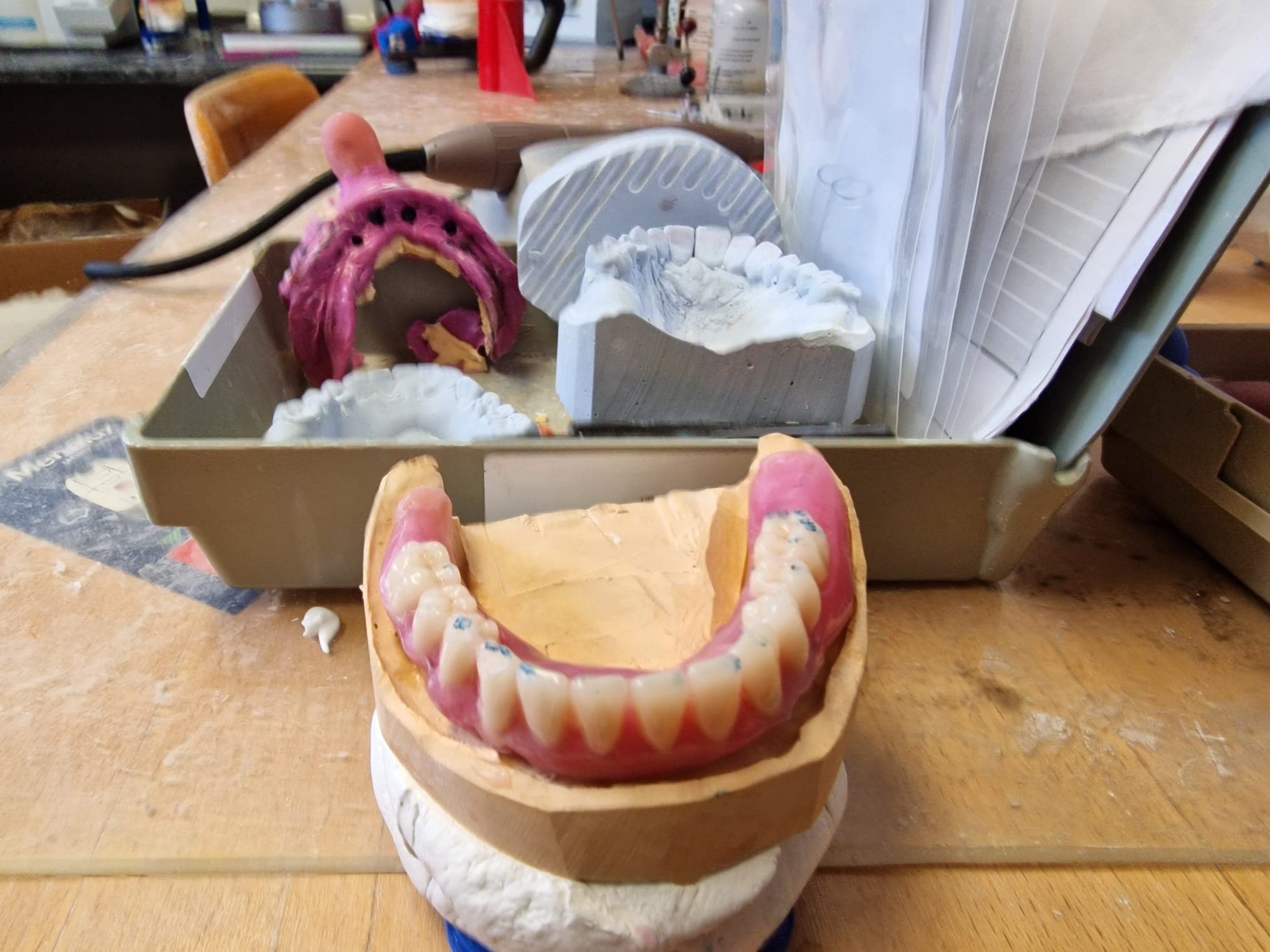 Zahnersatz auf Implantate - Bild 8