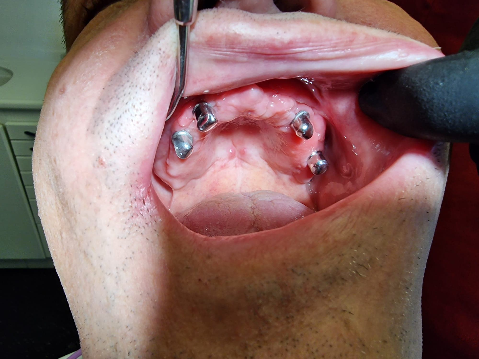 Teleskopierende Prothese - Bild 8